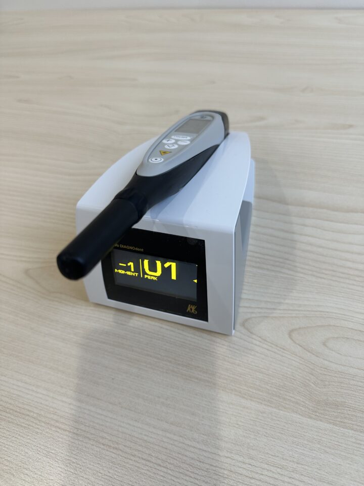 レーザーう蝕検知器
